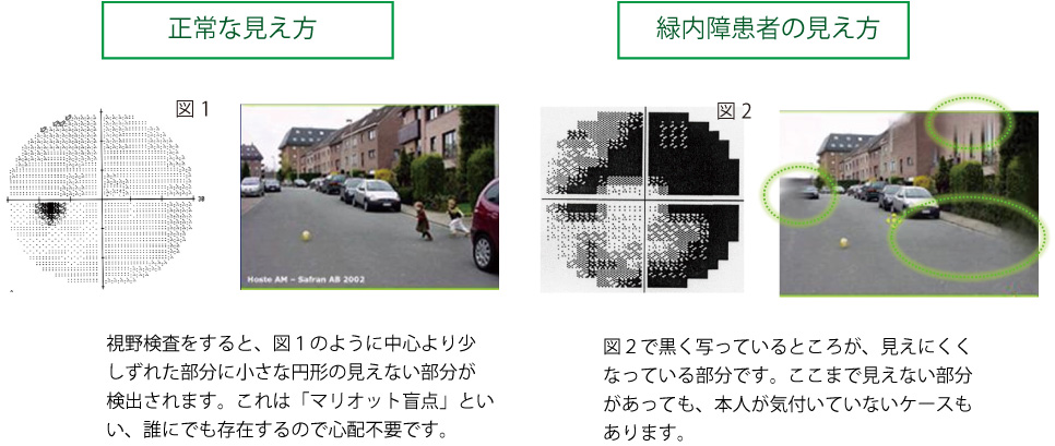 緑内障患者の見え方と正常な見え方