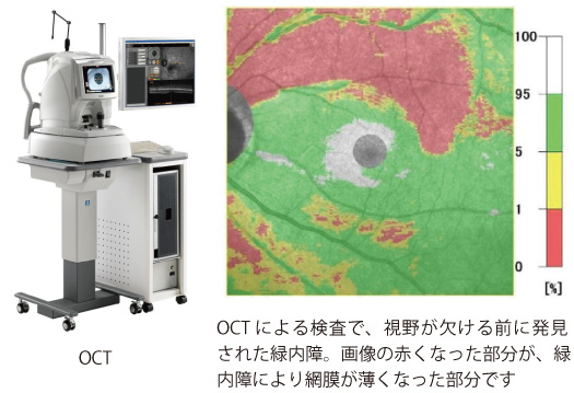 OCTによる検査で発見された緑内障。