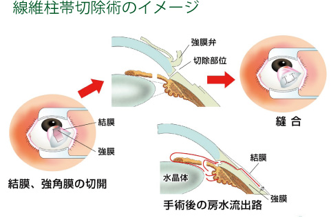 線維柱帯切除術のイメージ